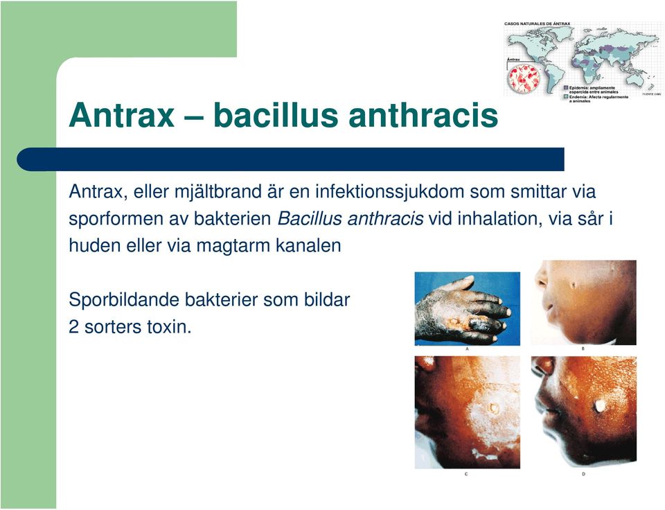 Bacillus anthracis vid inhalation, via sår i huden eller via