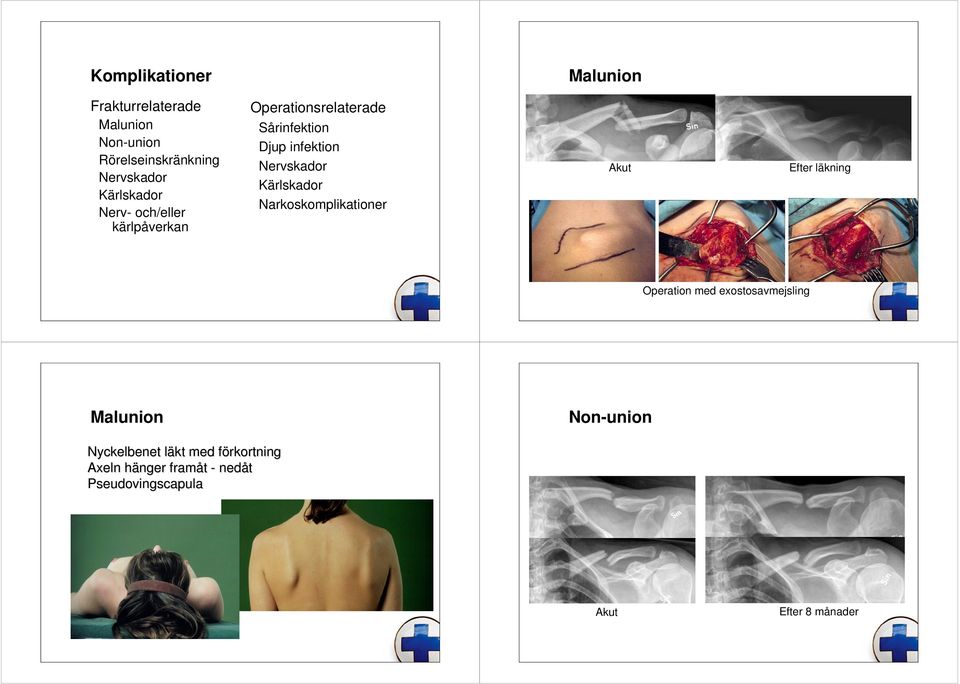 Nervskador Kärlskador Narkoskomplikationer Akut Efter läkning Operation med eostosavmejsling