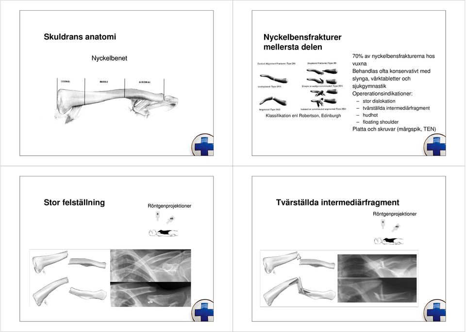 Opererationsindikationer: stor dislokation tvärställda intermediärfragment hudhot floating shoulder