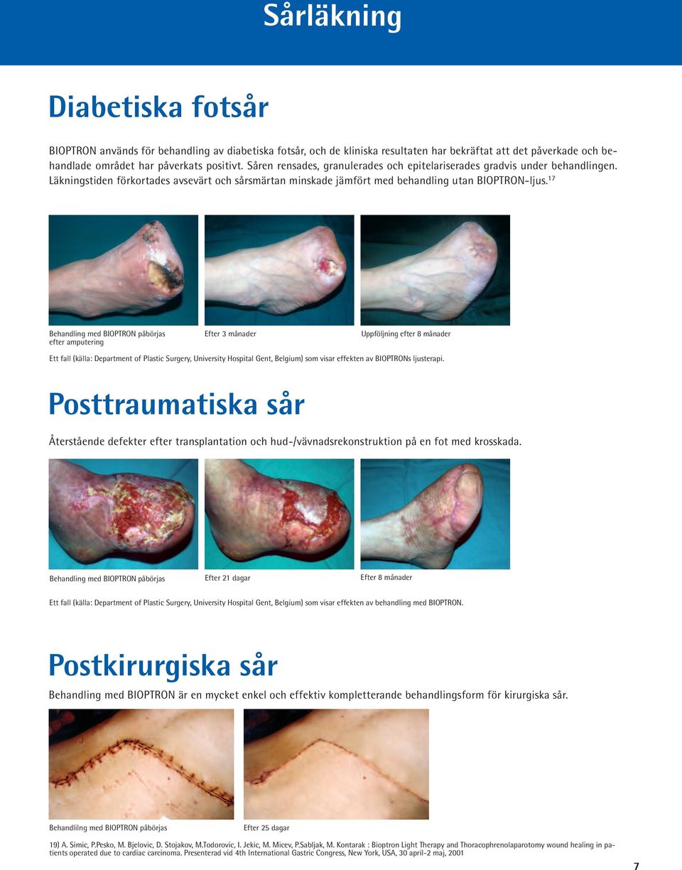 17 Behandling med BIOPTRON påbörjas efter amputering Efter 3 månader Uppföljning efter 8 månader Ett fall (källa: Department of Plastic Surgery, University Hospital Gent, Belgium) som visar effekten