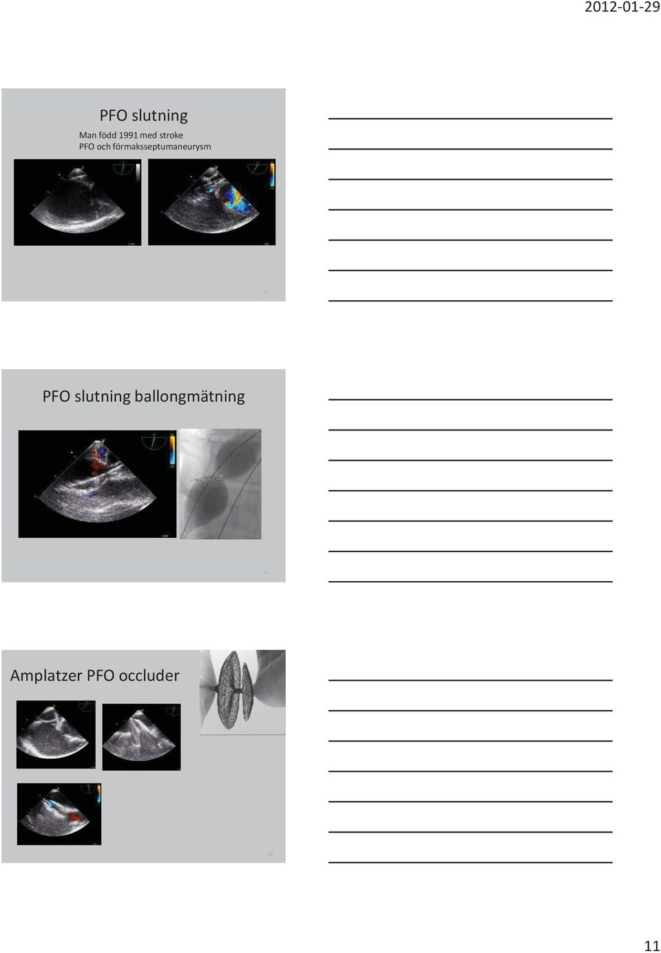 förmaksseptumaneurysm 31 PFO