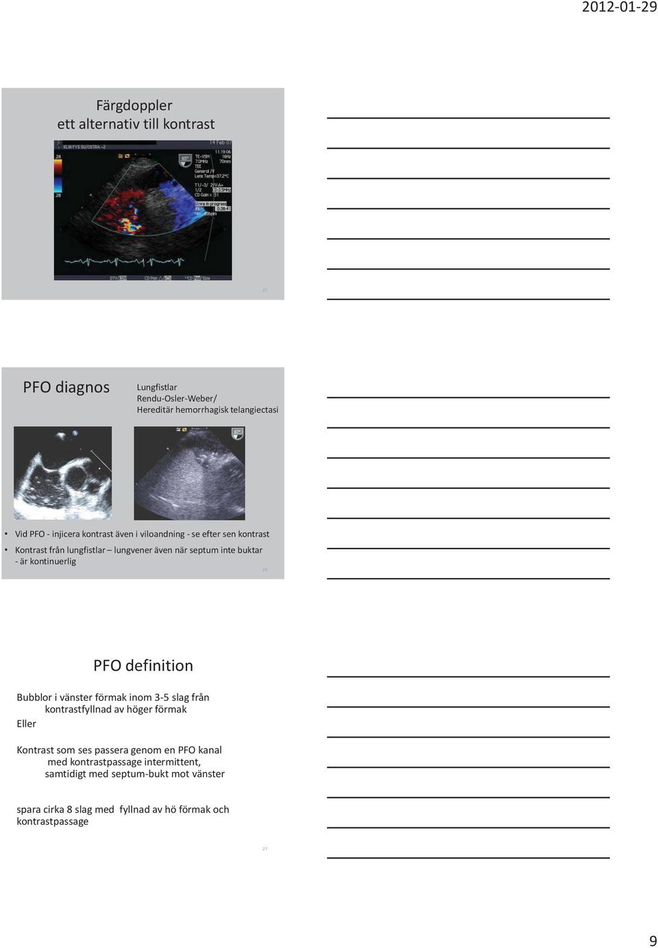 kontinuerlig 26 PFO definition Bubblor i vänster förmak inom 3-5 slag från kontrastfyllnad av höger förmak Eller Kontrast som ses passera
