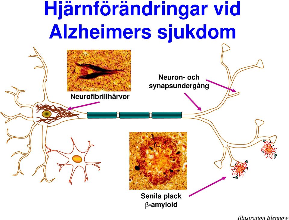 Neurofibrillhärvor Neuron- och