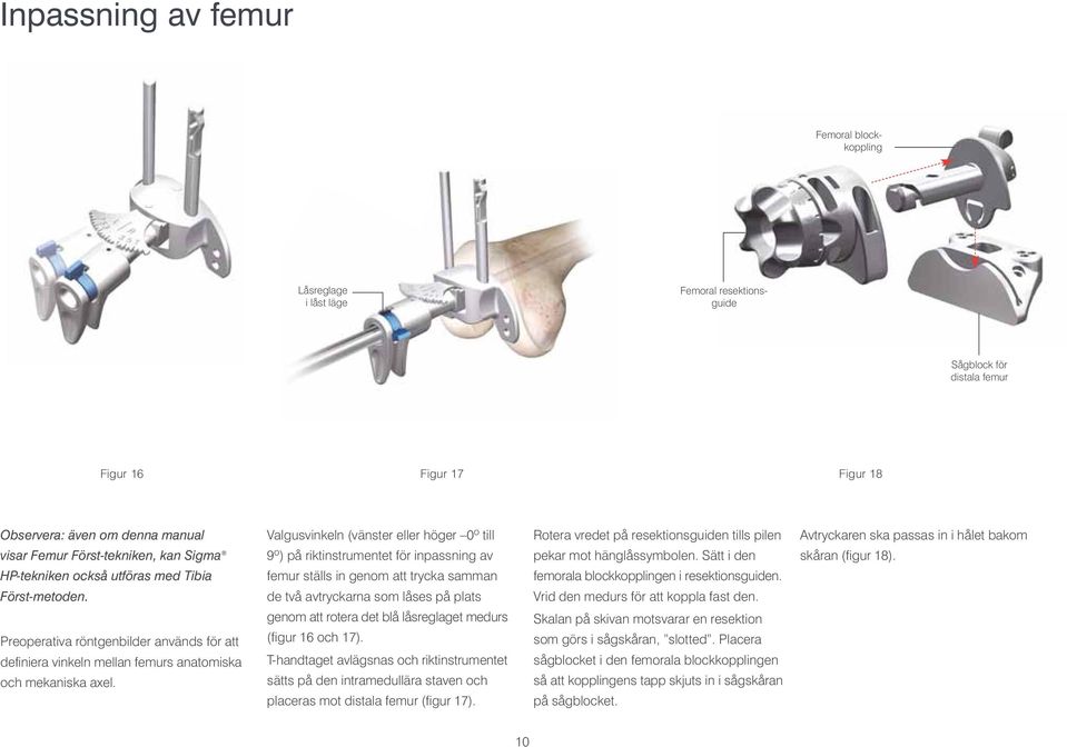 Valgusvinkeln (vänster eller höger 0º till 9º) på riktinstrumentet för inpassning av femur ställs in genom att trycka samman de två avtryckarna som låses på plats genom att rotera det blå låsreglaget