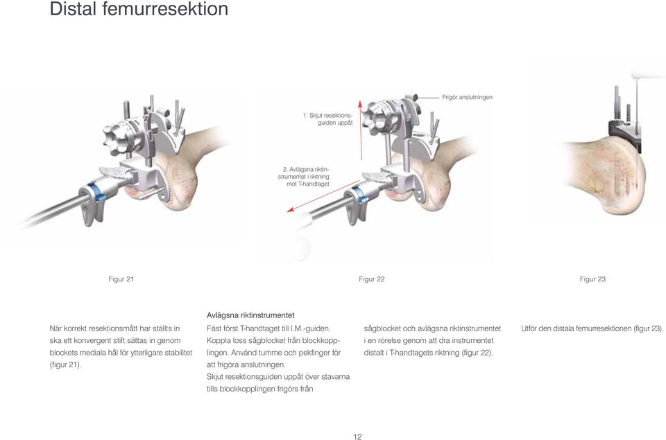 in genom blockets mediala hål för ytterligare stabilitet (figur 21). Fäst först T-handtaget till I.M.-guiden. Koppla loss sågblocket från blockkopplingen.