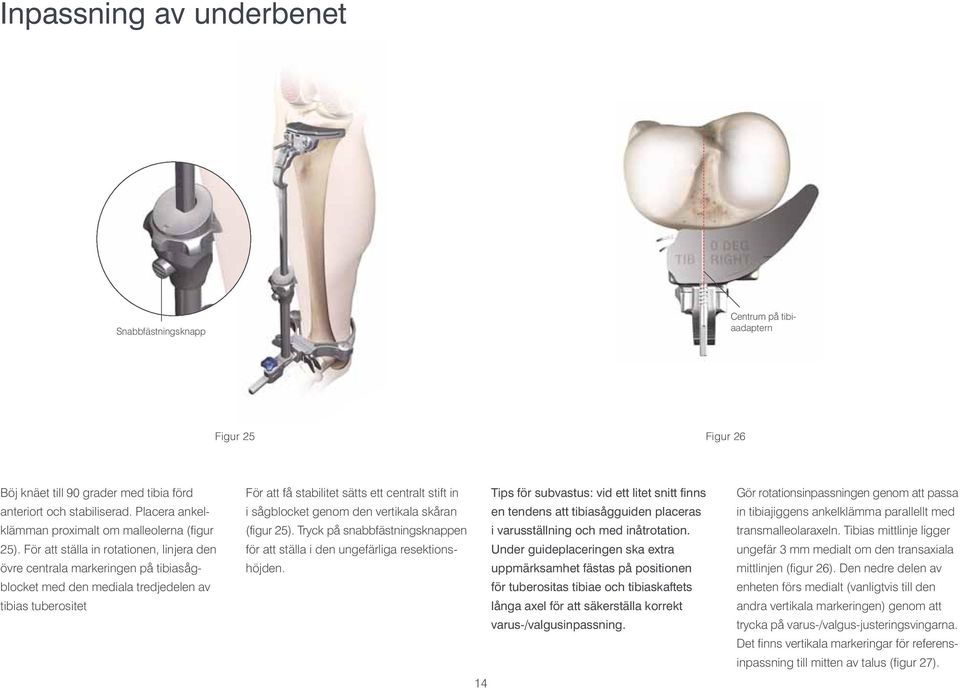 För att ställa in rotationen, linjera den övre centrala markeringen på tibiasågblocket med den mediala tredjedelen av tibias tuberositet För att få stabilitet sätts ett centralt stift in Tips för