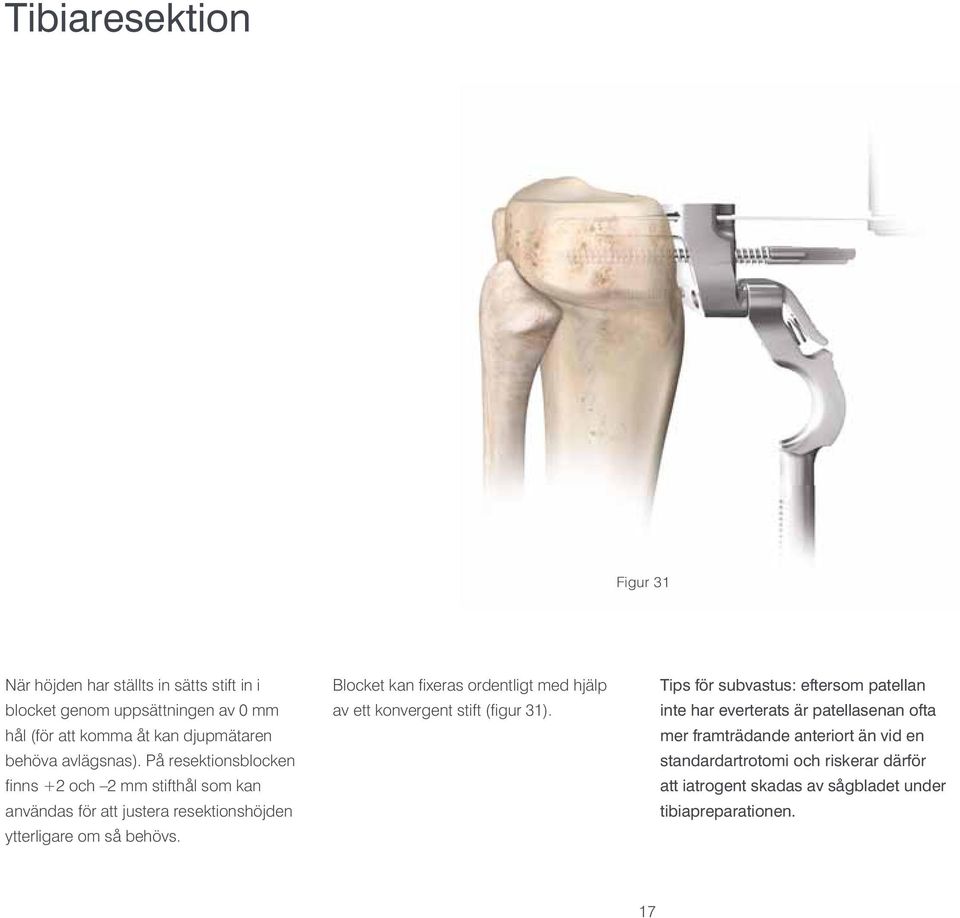 Blocket kan fixeras ordentligt med hjälp av ett konvergent stift (figur 31).