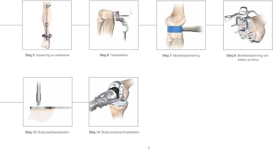 Storleksbestämning och rotation av femur Steg 13: