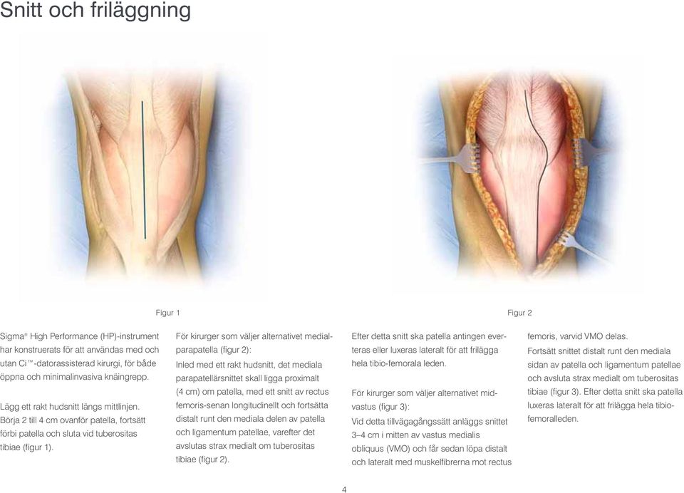 För kirurger som väljer alternativet medialparapatella (figur 2): Inled med ett rakt hudsnitt, det mediala parapatellärsnittet skall ligga proximalt (4 cm) om patella, med ett snitt av rectus