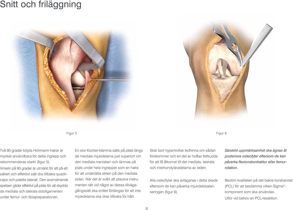 Den av smal nande spetsen glider effektivt på plats för att skydda de mediala och laterala sido liga menten under femur- och tibiapreparationen.