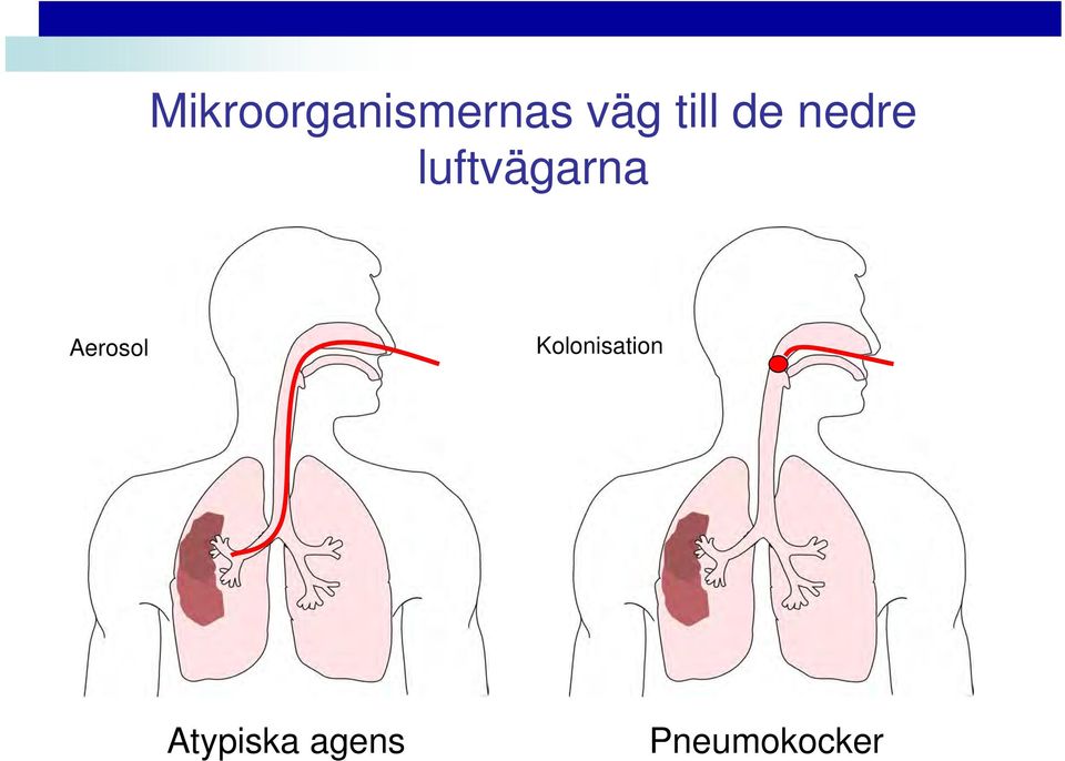 luftvägarna Aerosol