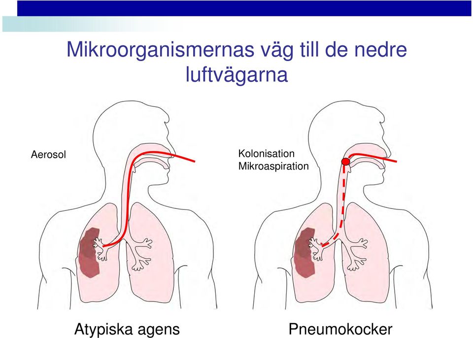 Kolonisation Mikroaspiration