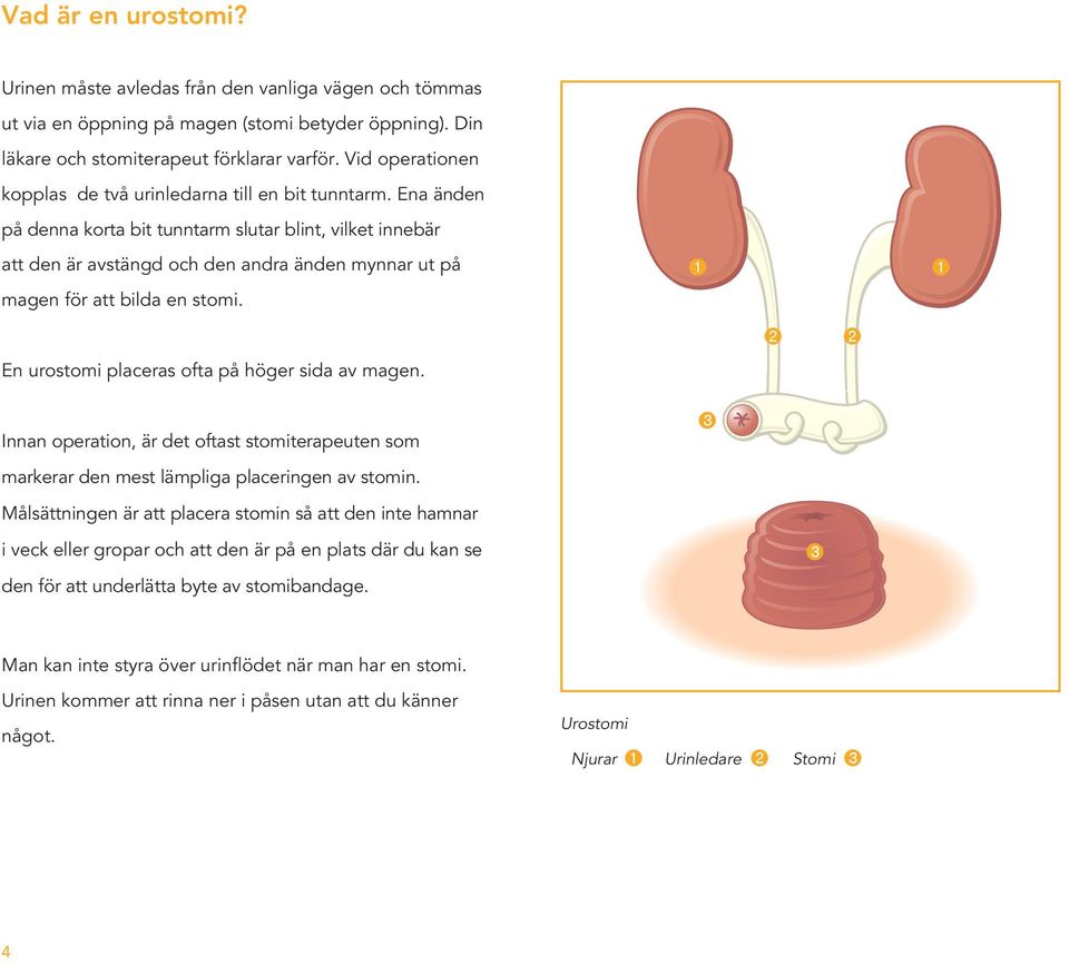 Ena änden på denna korta bit tunntarm slutar blint, vilket innebär att den är avstängd och den andra änden mynnar ut på magen för att bilda en stomi. En urostomi placeras ofta på höger sida av magen.