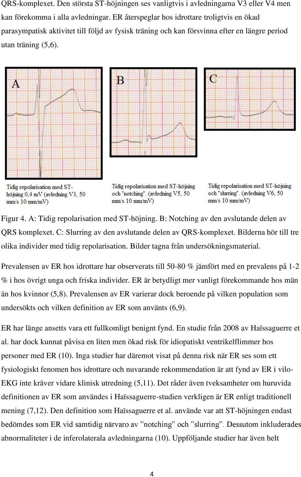 A: Tidig repolarisation med ST-höjning. B: Notching av den avslutande delen av QRS komplexet. C: Slurring av den avslutande delen av QRS-komplexet.