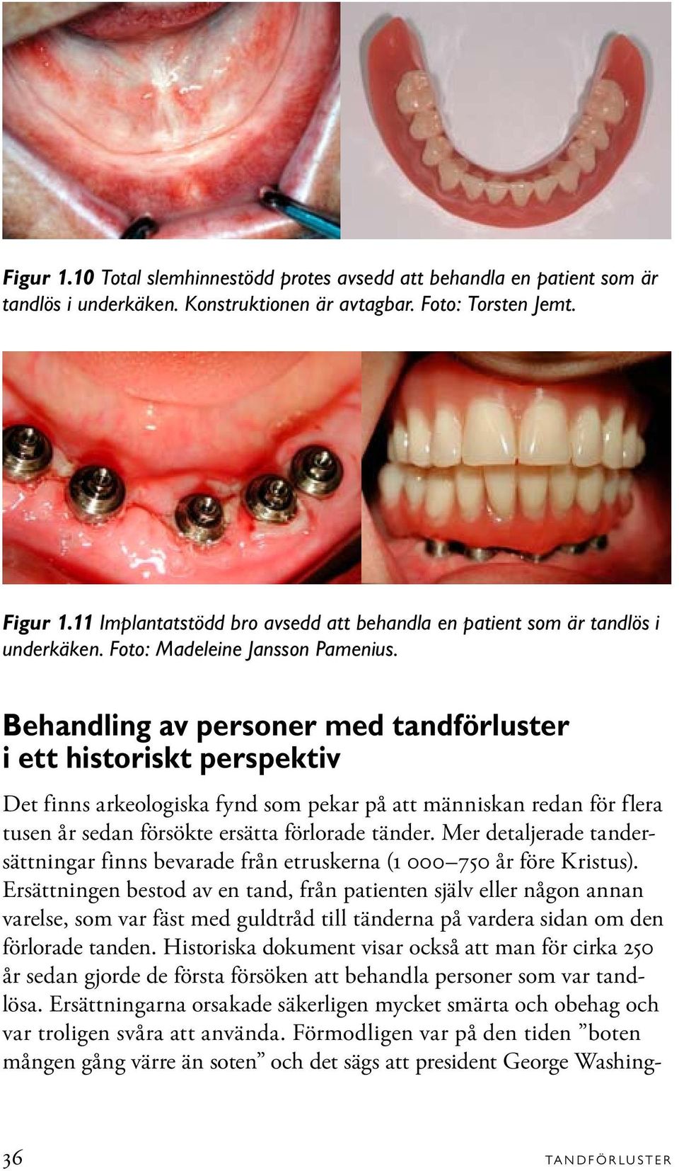 Behandling av personer med tandförluster i ett historiskt perspektiv Det finns arkeologiska fynd som pekar på att människan redan för flera tusen år sedan försökte ersätta förlorade tänder.