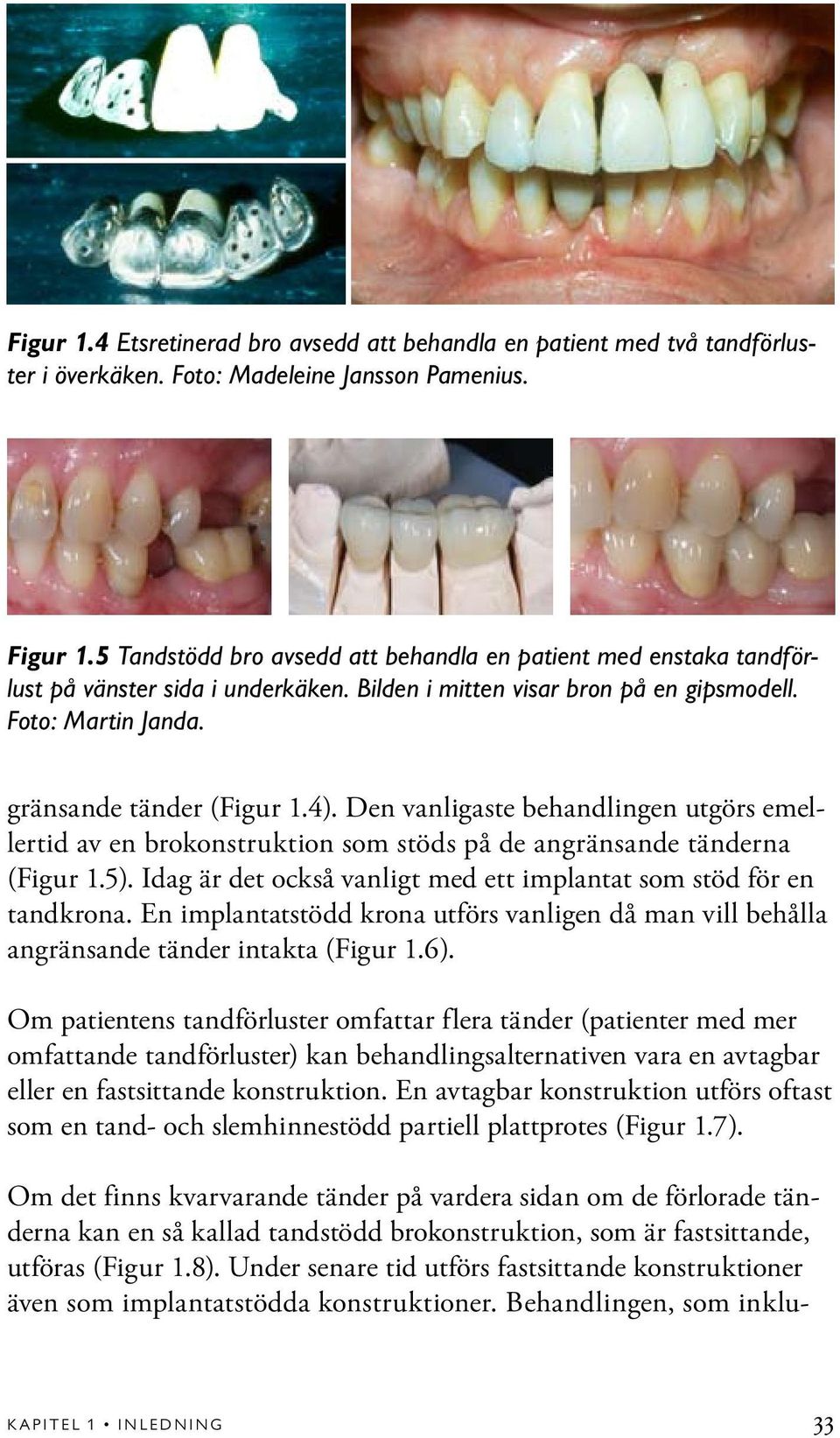 Den vanligaste behandlingen utgörs emellertid av en brokonstruktion som stöds på de angränsande tänderna (Figur 1.5). Idag är det också vanligt med ett implantat som stöd för en tandkrona.