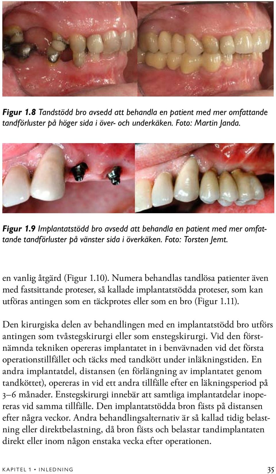 Numera behandlas tandlösa patienter även med fastsittande proteser, så kallade implantatstödda proteser, som kan utföras antingen som en täckprotes eller som en bro (Figur 1.11).