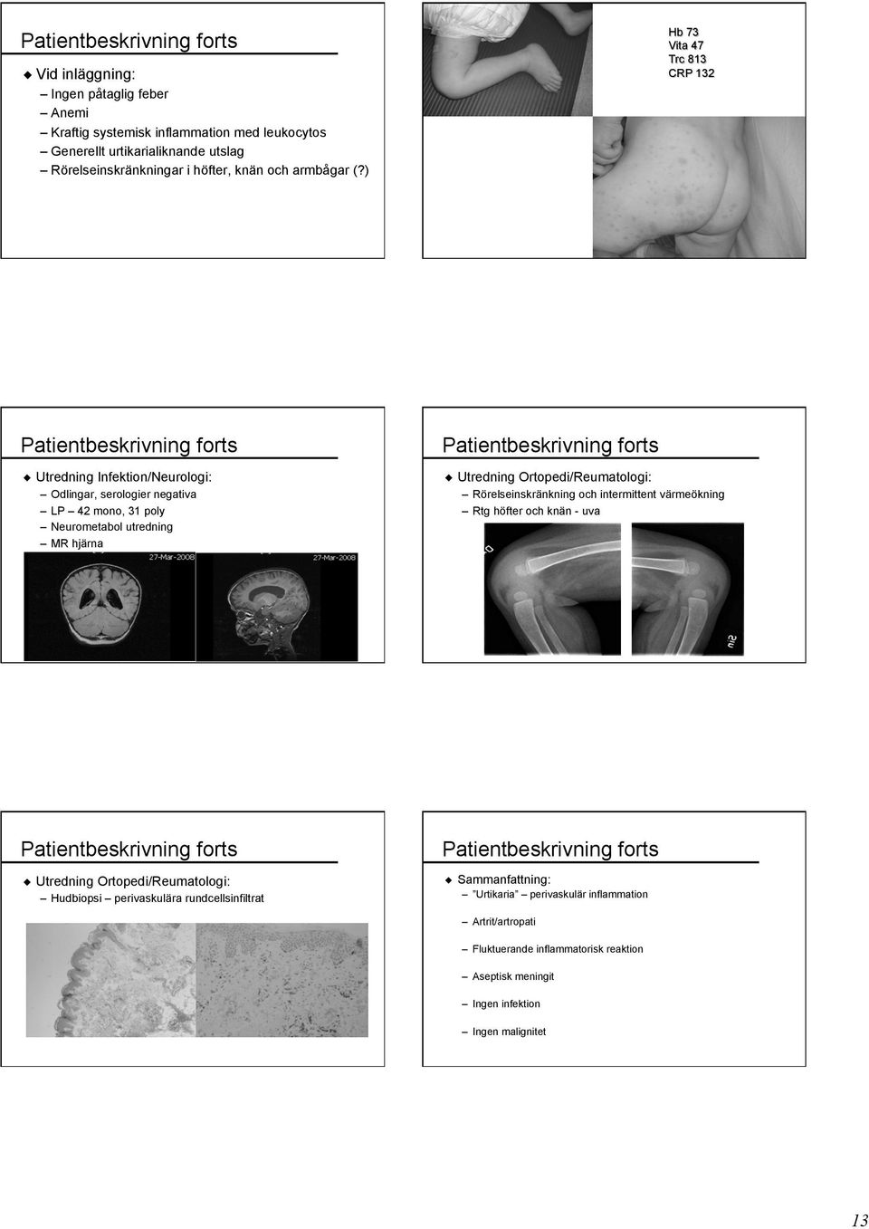 ) Hb 73 Vita 47 Trc 813 CRP 132 Patientbeskrivning forts Utredning Infektion/Neurologi: Odlingar, serologier negativa LP 42 mono, 31 poly Neurometabol utredning MR hjärna Patientbeskrivning forts