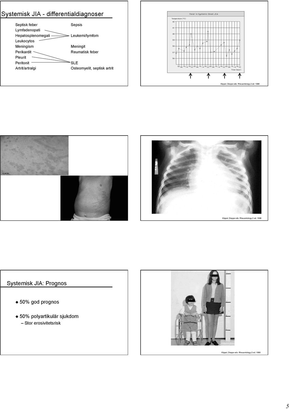 septisk artrit Klippel, Dieppe eds. Rheuamtology 2 ed.