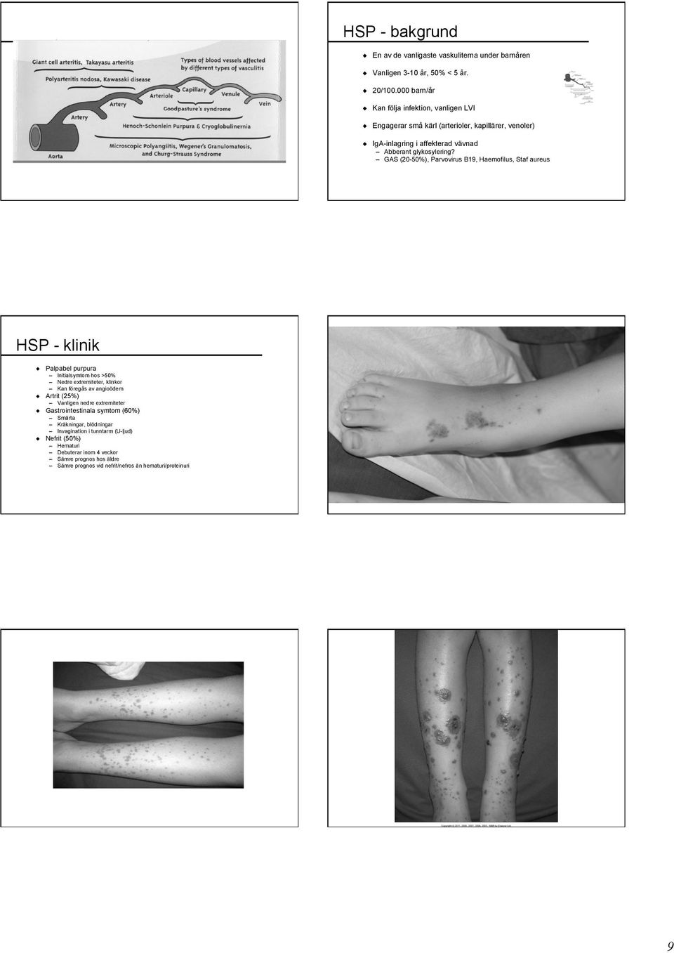 GAS (20-50%), Parvovirus B19, Haemofilus, Staf aureus HSP - klinik Palpabel purpura Initialsymtom hos >50% Nedre extremiteter, klinkor Kan föregås av angioödem Artrit