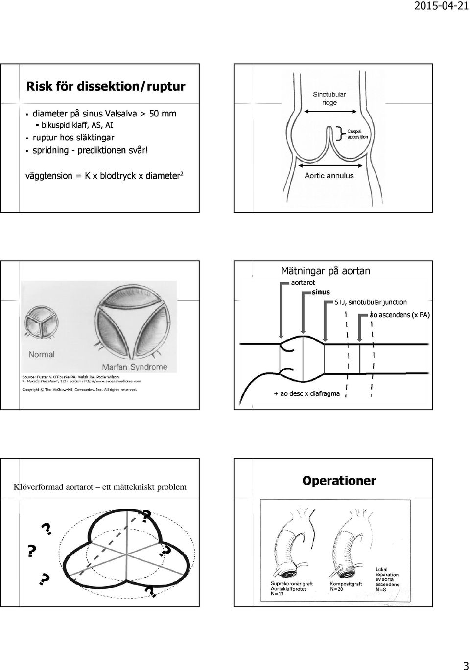 väggtension = K x blodtryck x diameter 2 Mätningar på aortan aortarot sinus STJ,