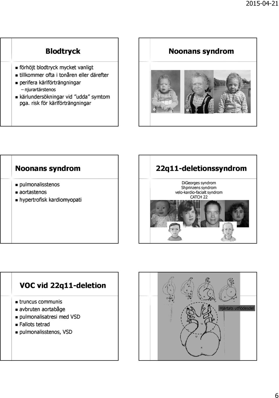 risk för kärlförträngningar Noonans syndrom pulmonalisstenos aortastenos hypertrofisk kardiomyopati 22q11-deletionssyndrom DiGeorges