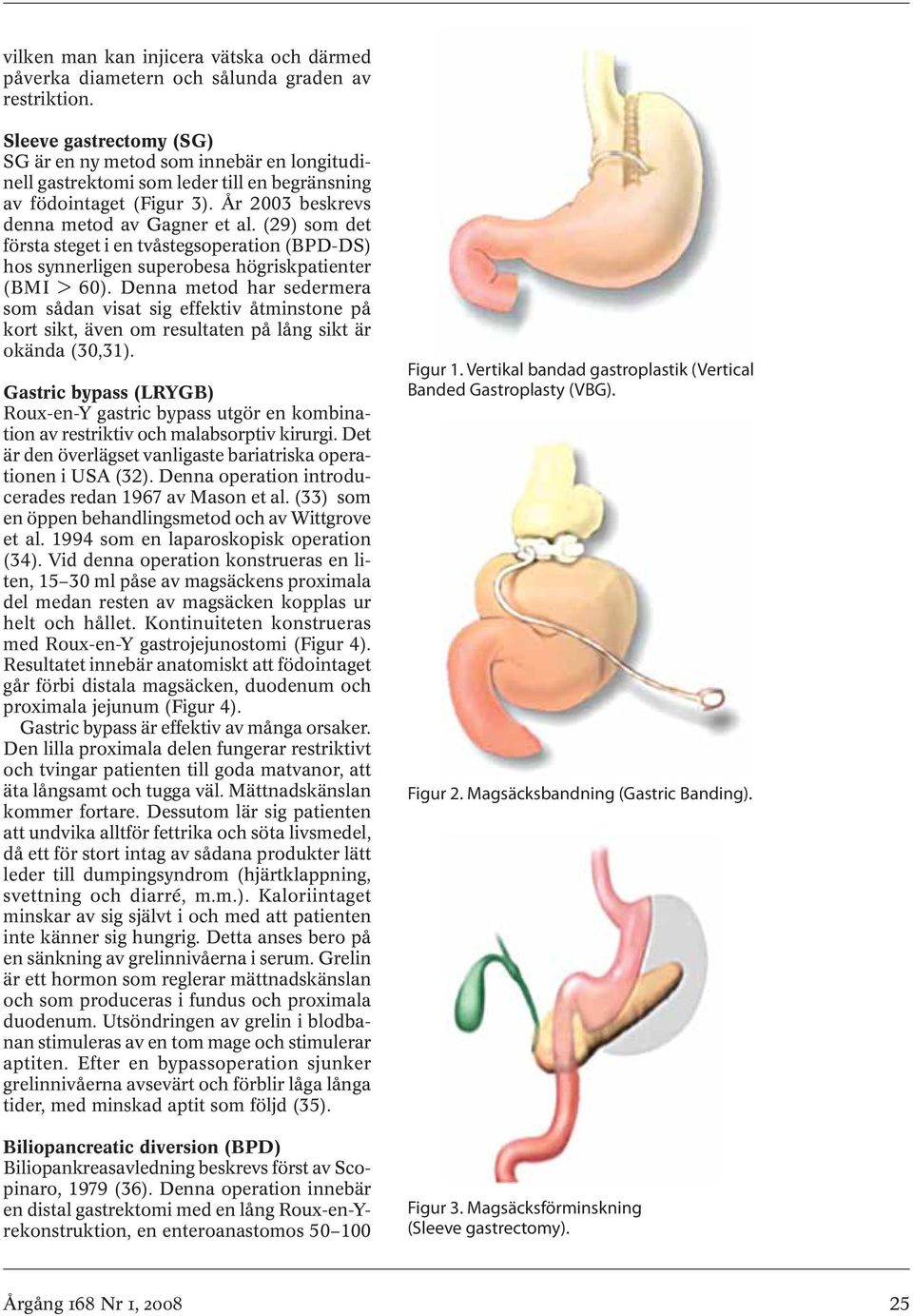 (29) som det första steget i en tvåstegsoperation (BPD-DS) hos synnerligen superobesa högriskpatienter (BMI > 60).