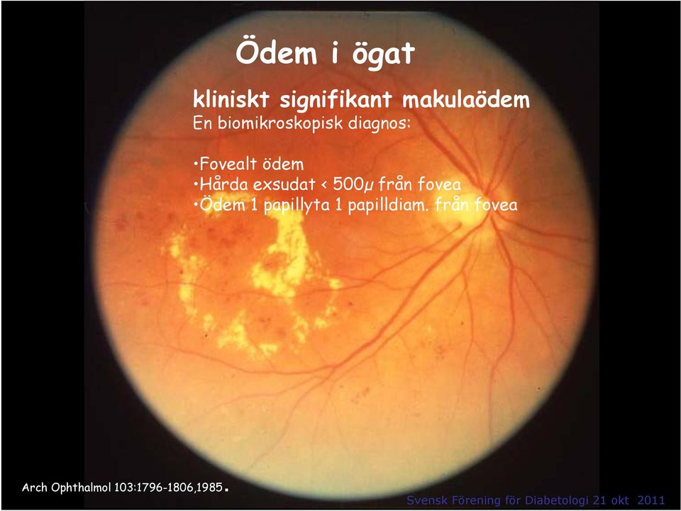 exsudat < 500µ från fovea Ödem 1 papillyta 1