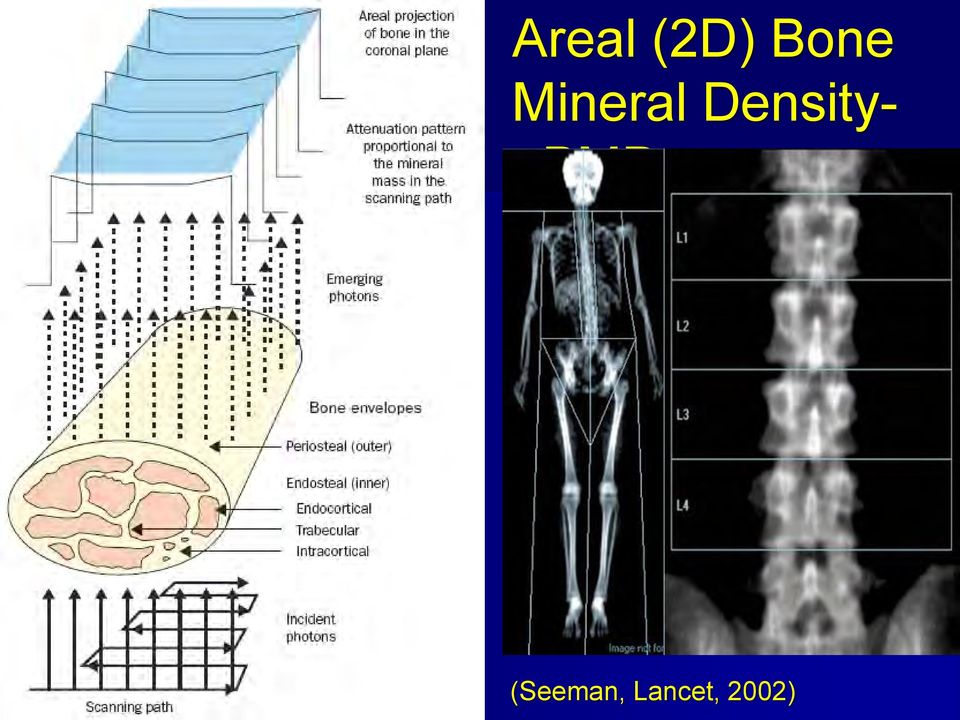 DensityaBMD