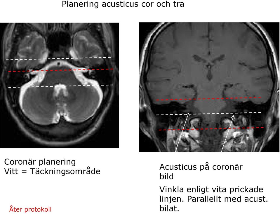 Acusticus på coronär bild Vinkla enligt