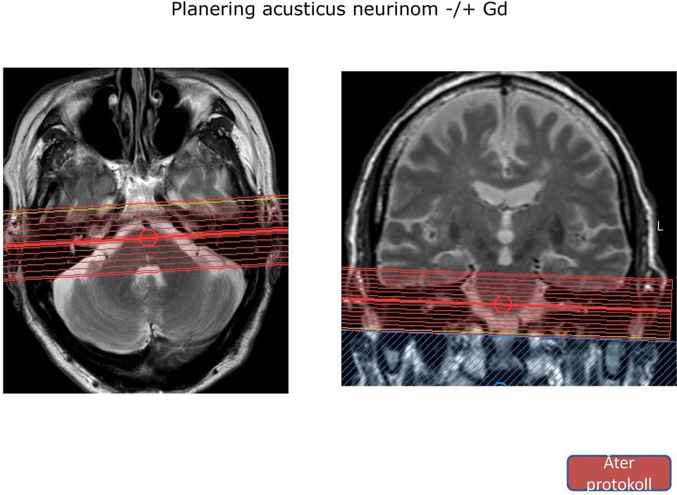 neurinom -/+