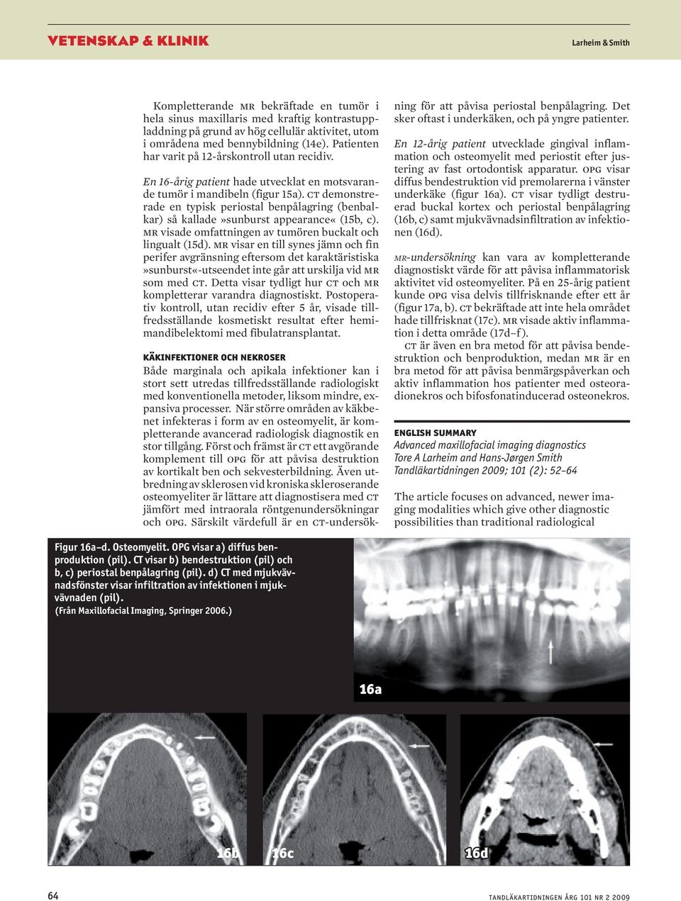 ct demonstrerade en typisk periostal benpålagring (benbalkar) så kallade»sunburst appearance«(15b, c). mr visade omfattningen av tumören buckalt och lingualt (15d).