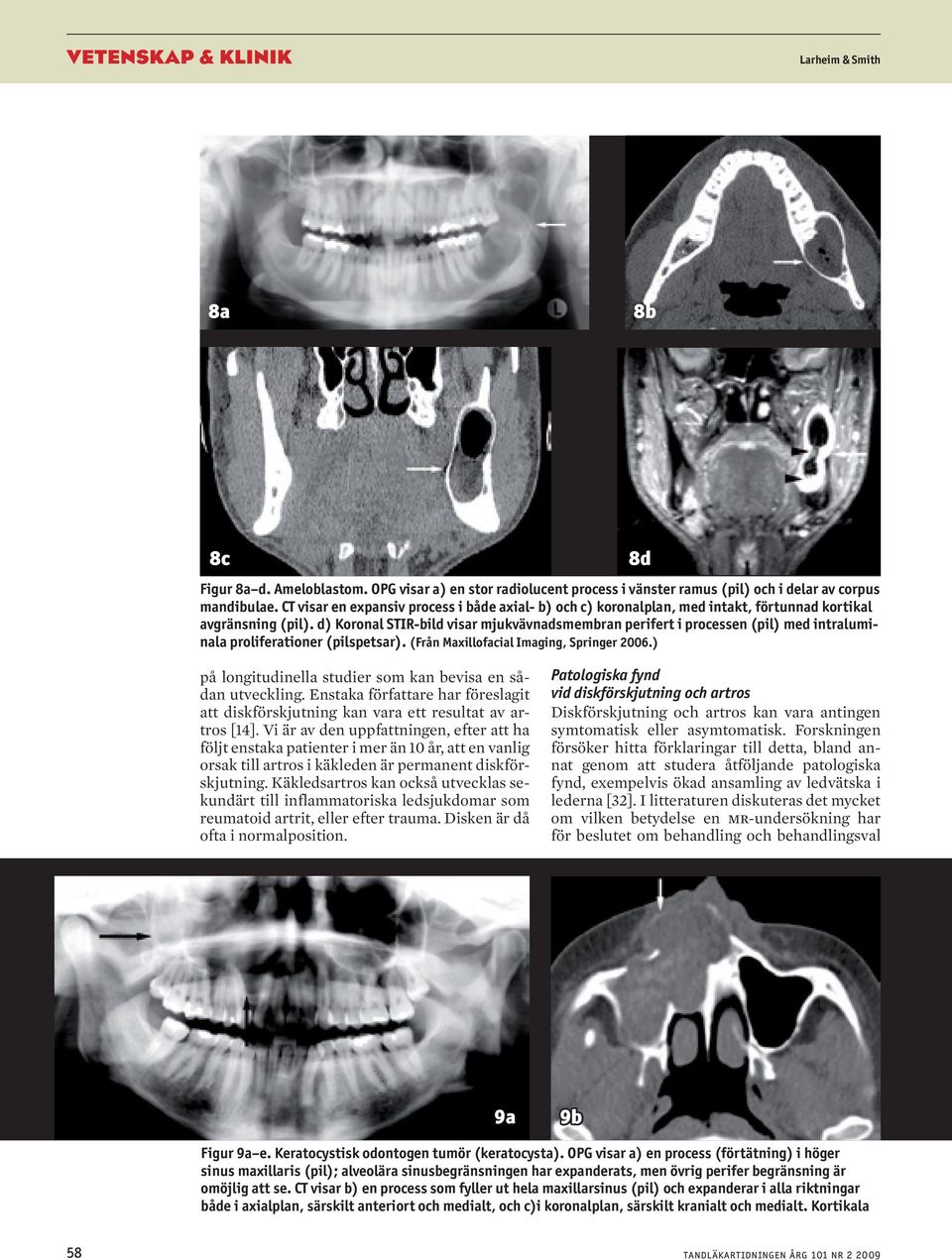 d) Koronal STIR-bild visar mjukvävnadsmembran perifert i processen (pil) med intraluminala proliferationer (pilspetsar). 8d på longitudinella studier som kan bevisa en sådan utveckling.