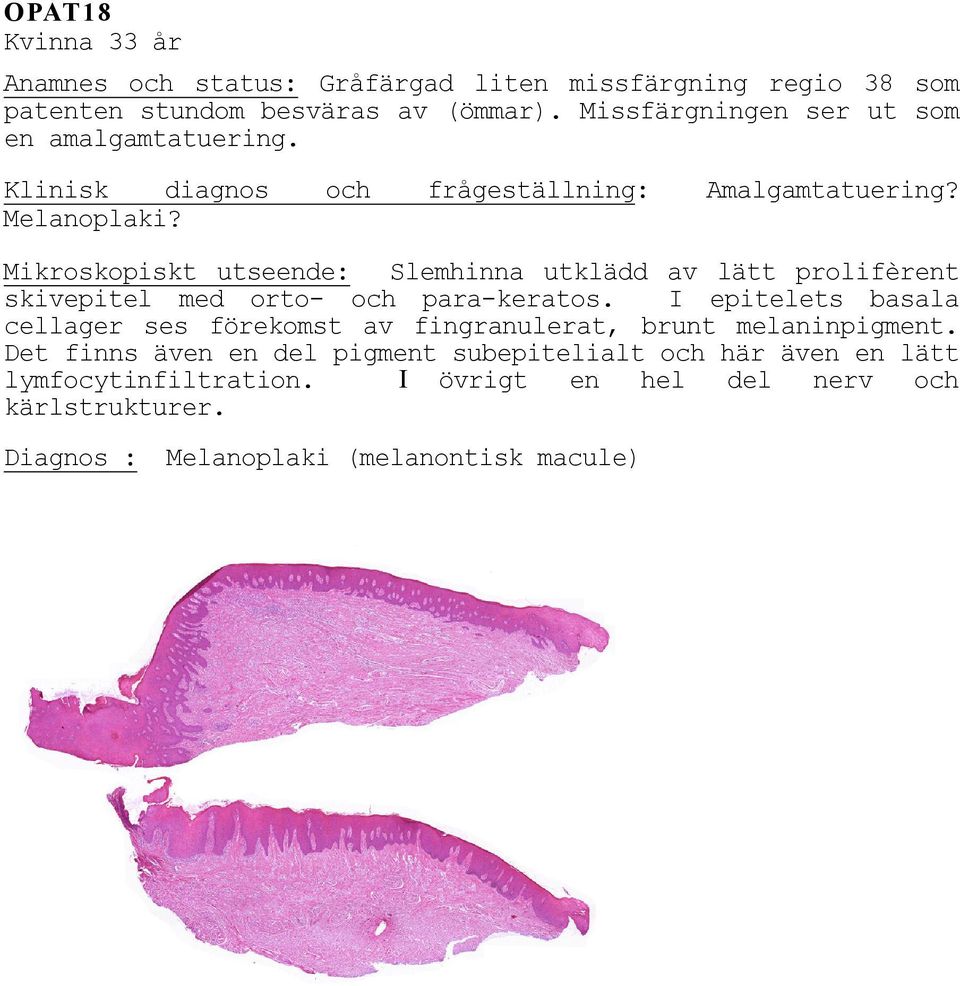 Mikroskopiskt utseende: Slemhinna utklädd av lätt prolifèrent skivepitel med orto- och para-keratos.