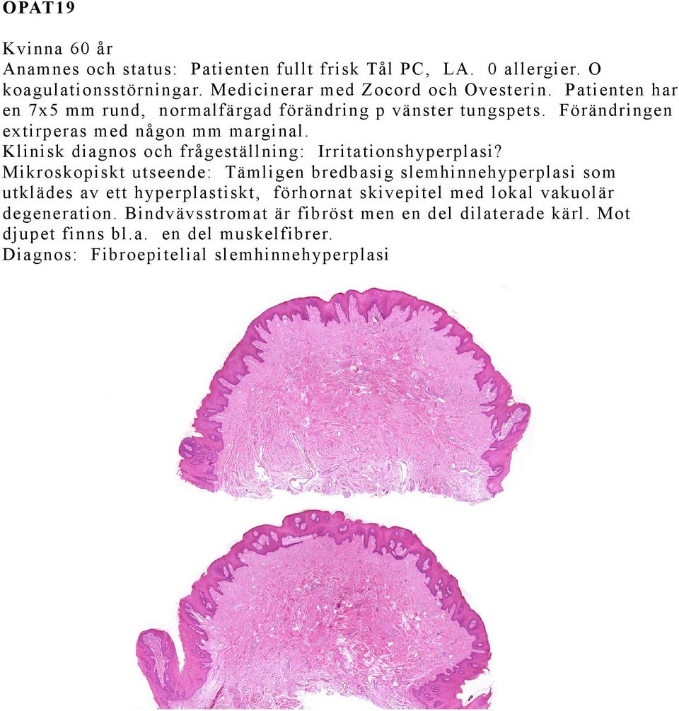 Klinisk diagnos och frågeställning: Irritationshyperplasi?