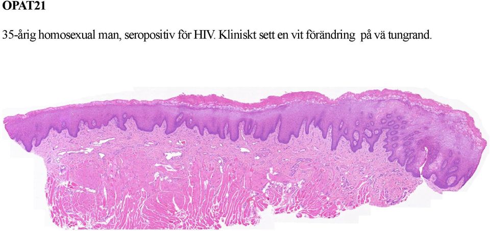 seropositiv för HIV.