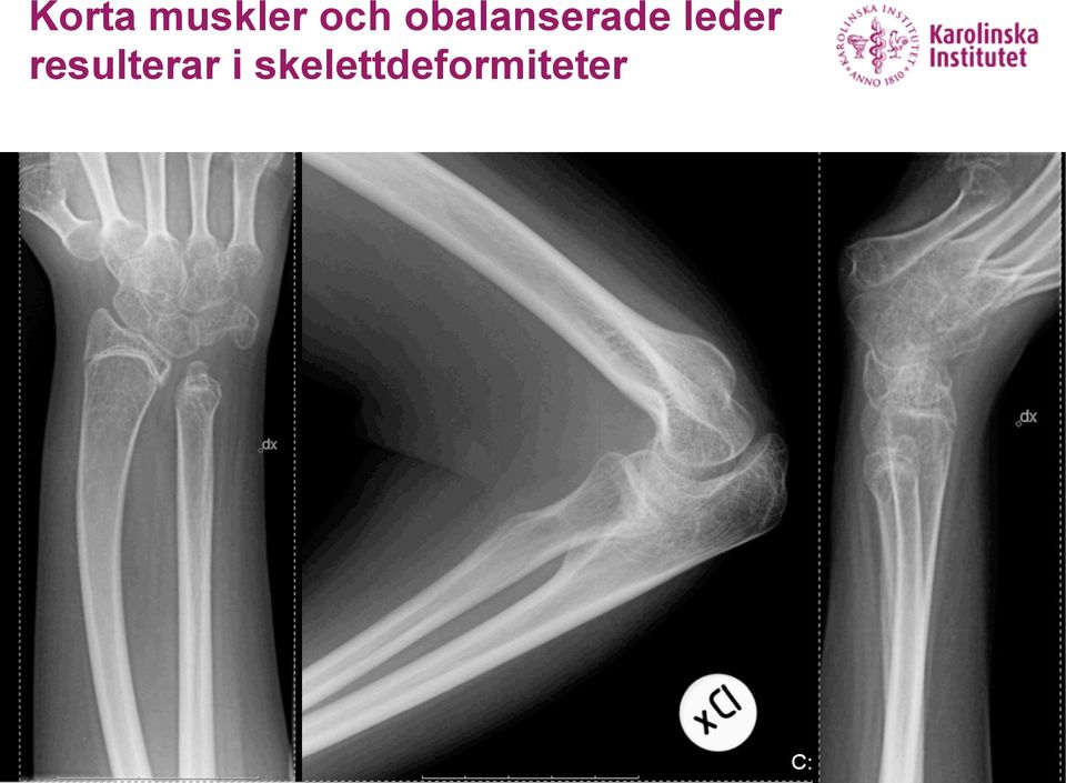 leder resulterar
