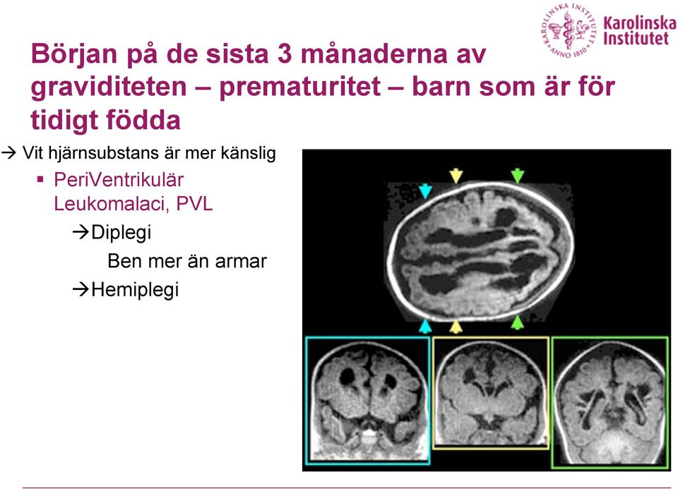 hjärnsubstans är mer känslig PeriVentrikulär