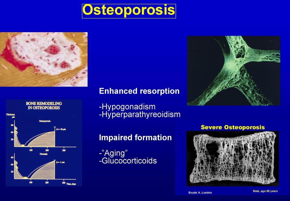 Impaired formation Severe Osteoporosis -