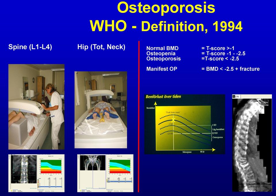 >-1 Osteopenia = T-score -1 - -2.