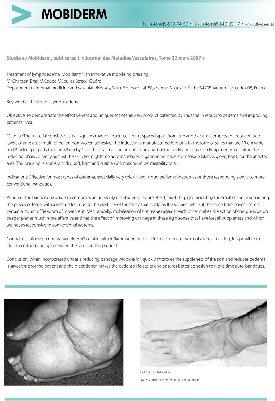 Key words Treatment: lymphoedema Objective: To demonstrate the effectiveness and uniqueness of this new product patented by Thuasne in reducing oedema and improving patient s lives.