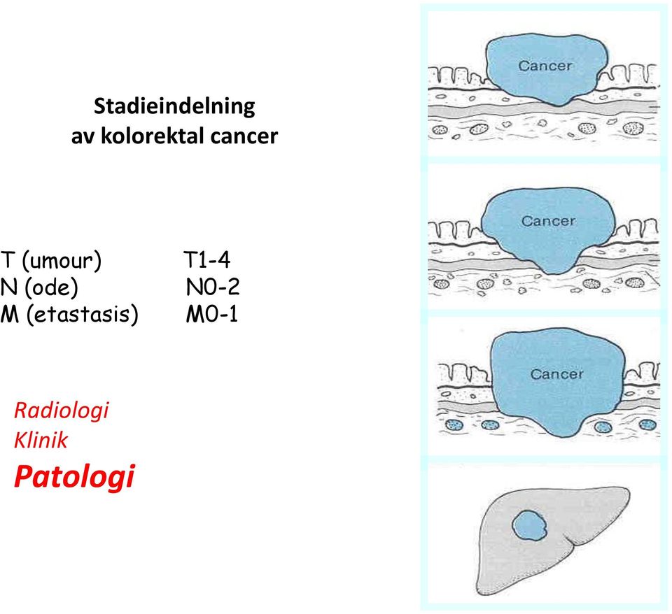 (ode) N0-2 M (etastasis) M0-1