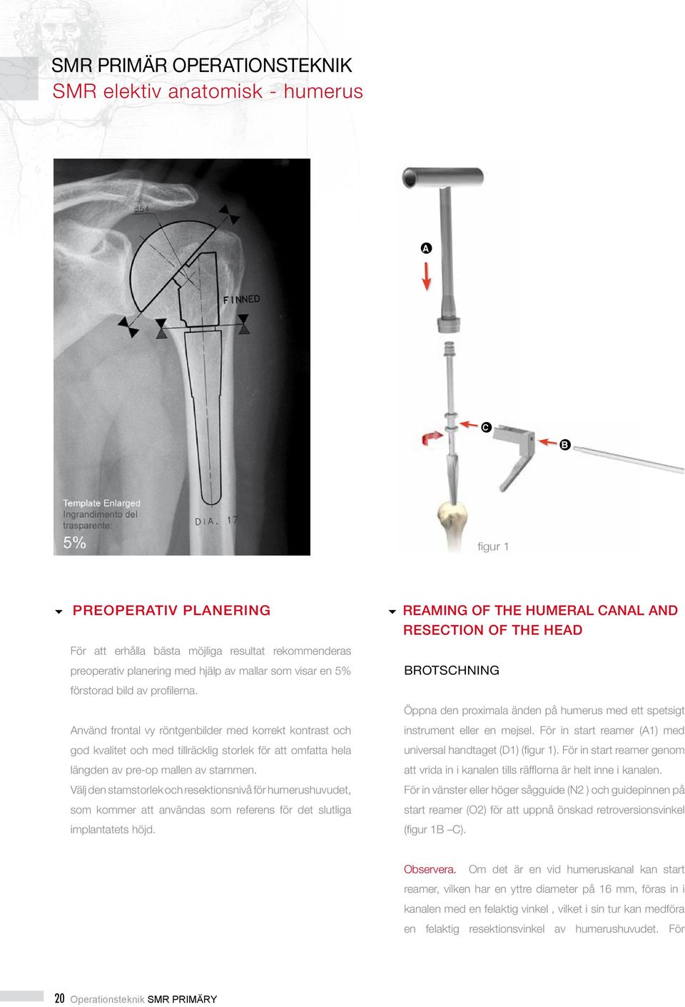 REAMING OF THE HUMERAL CANAL AND RESECTION OF THE HEAD BROTSCHNING Öppna den proximala änden på humerus med ett spetsigt Använd frontal vy röntgenbilder med korrekt kontrast och god kvalitet och med