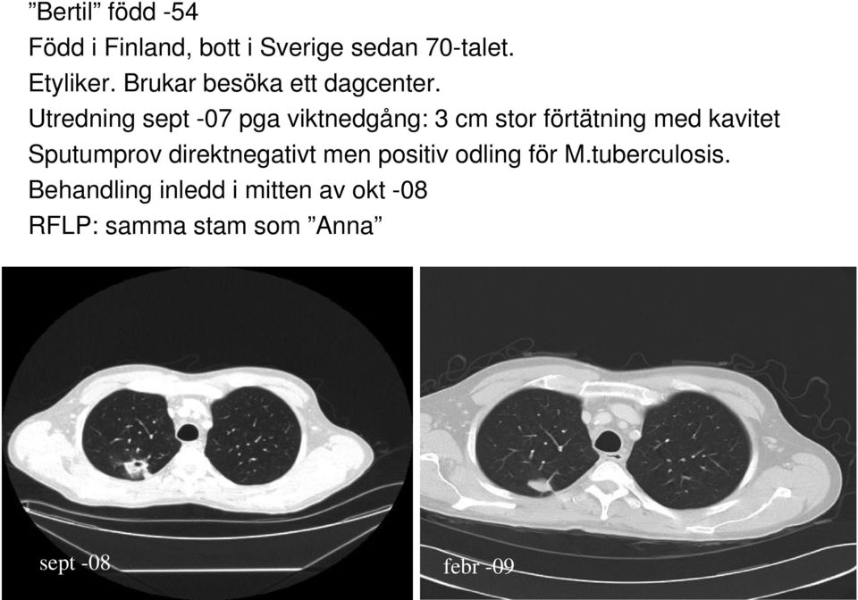 Utredning sept -07 pga viktnedgång: 3 cm stor förtätning med kavitet Sputumprov