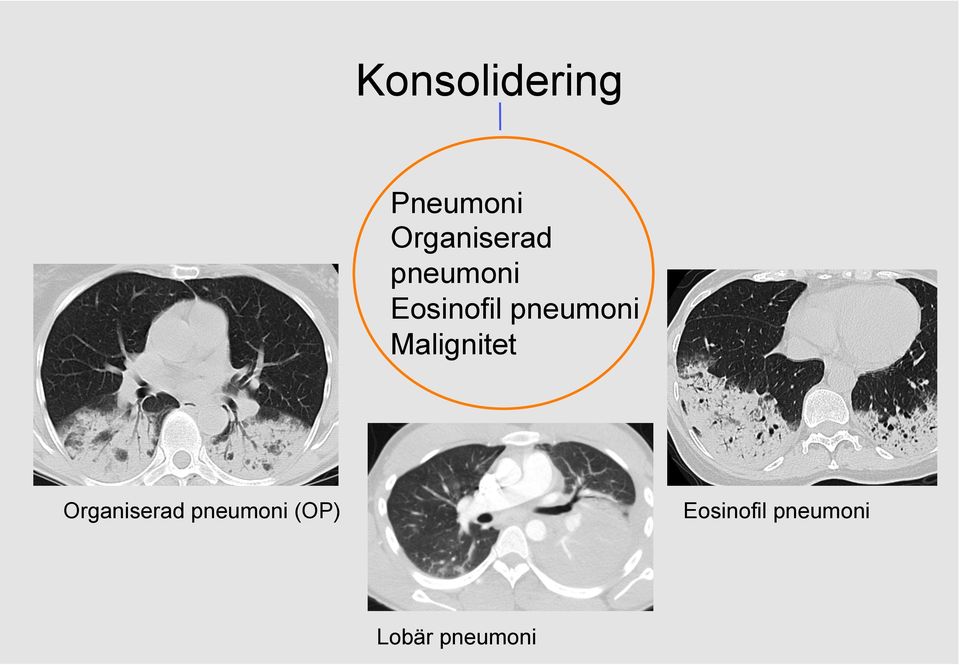 pneumoni Malignitet Organiserad