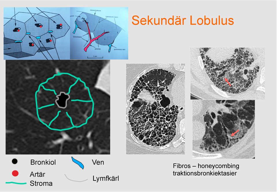 Stroma Lymfkärl Fibros