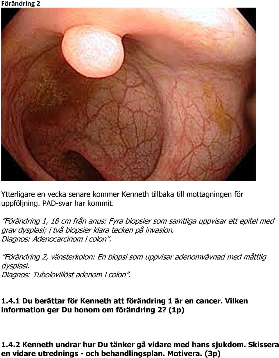 Diagnos: Adenocarcinom i colon. Förändring 2, vänsterkolon: En biopsi som uppvisar adenomvävnad med måttlig dysplasi. Diagnos: Tubolovillöst adenom i colon. 1.4.