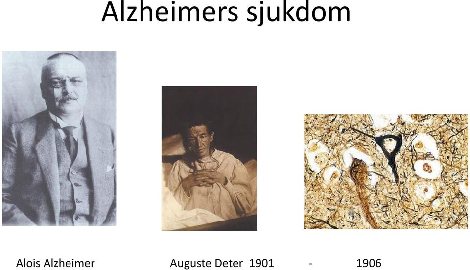 Alzheimer