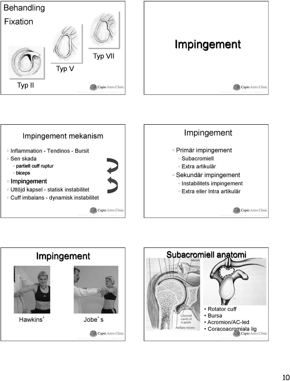 Cuff imbalans - dynamisk instabilitet Impingement! Primär impingement! Subacromiell! Extra artikulär!