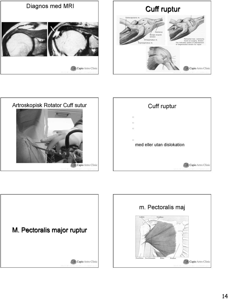 Supraspinatus + Subscapularis!